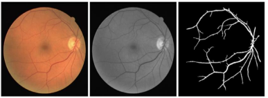 Project Retinal Blood Vessel Segmentation